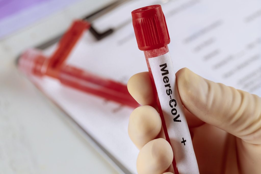 MERS virus definition Middle East Respiratory Syndrome Blood sample test